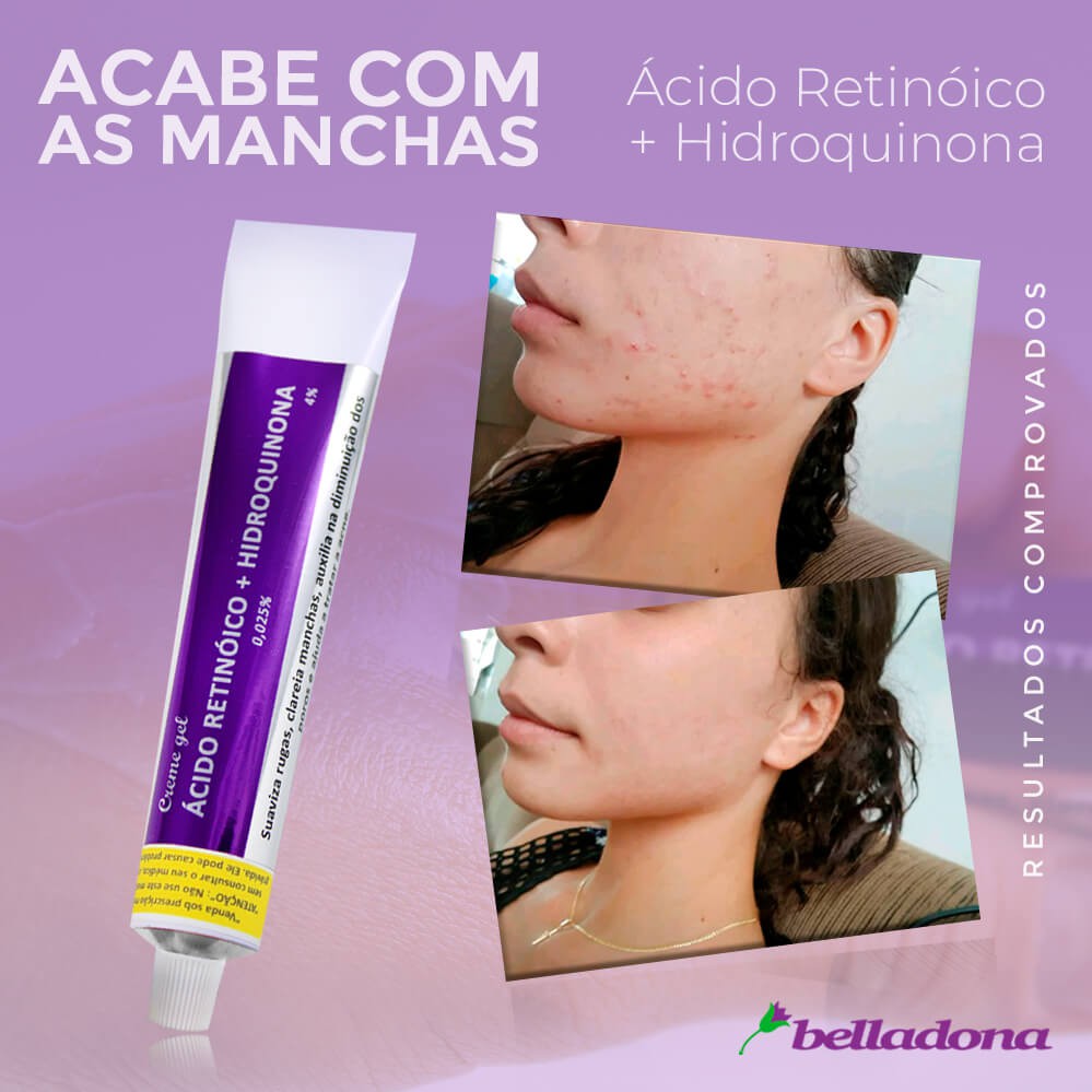 Ácido Retinóico e Hidroquinona Clareador AntiMelasma Farmácia