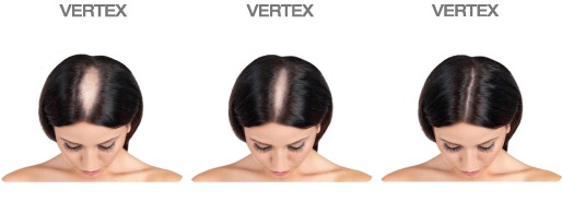 Evolução do tratamento com Minoxidil 2% para mulheres na região do vértice mostrando melhora progressiva no volume capilar feminino