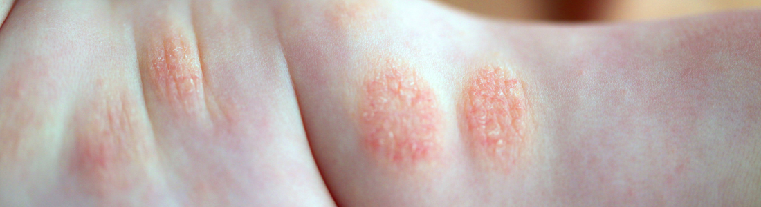 Como Tratar Dermatite Atópica em Crianças com Produtos Naturais