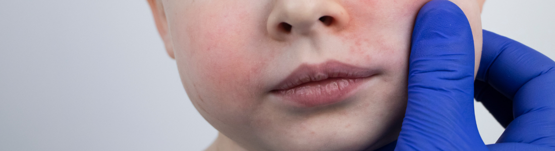 Dermatite Atópica: Como Identificar e Tratar em Crianças com Produtos Naturais