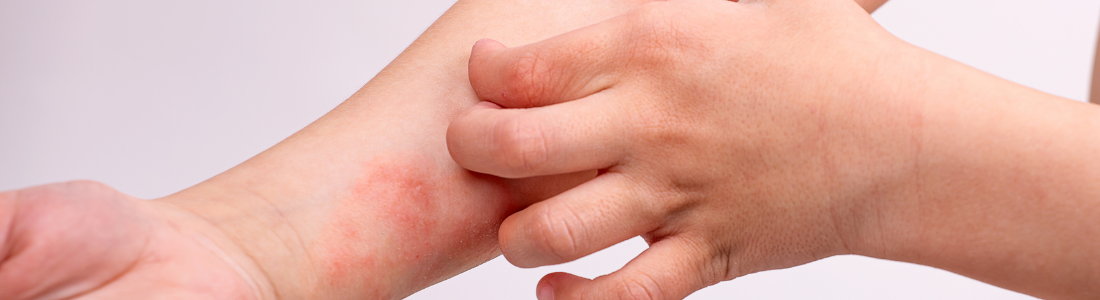 Dermatite Atópica no Verão