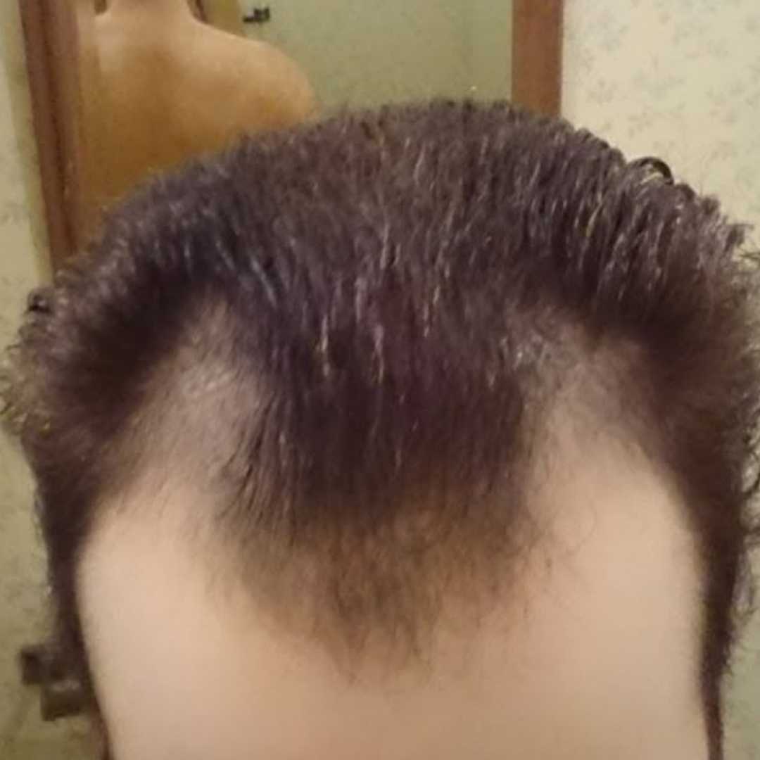 Cabelo fraco antes do tratamento