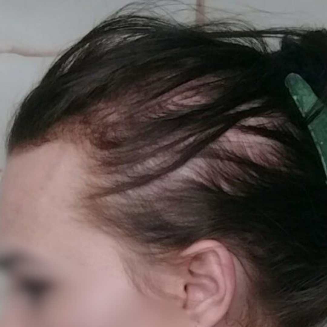 Cabelo ralo antes do tratamento