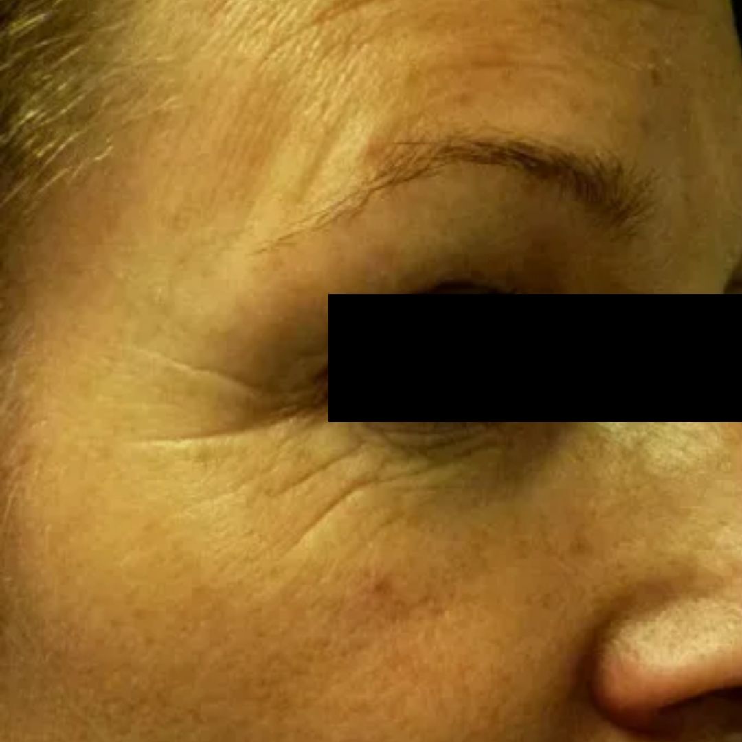 Pele com rugas antes do Sérum Ozo Be