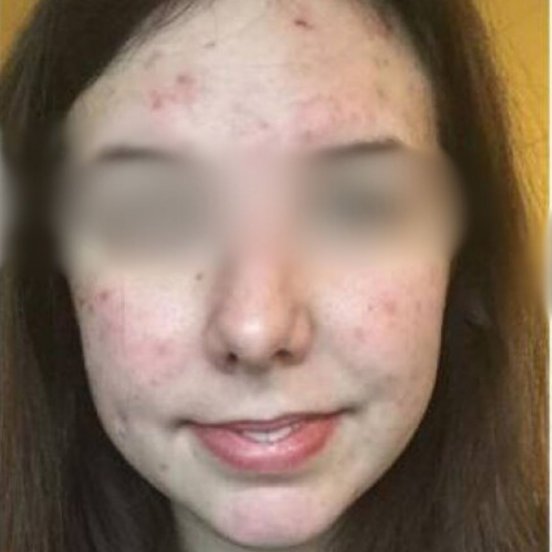 Pele com acne antes do Sérum Ozo Be