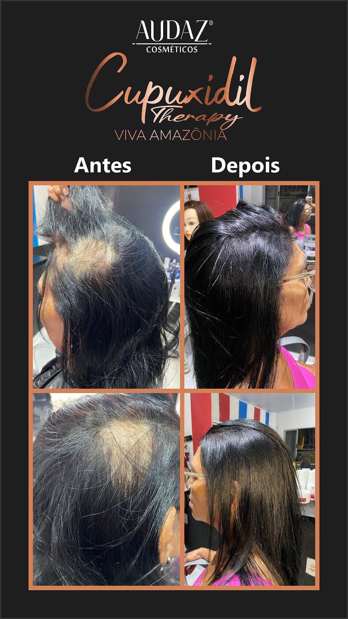 Tônico de Crescimento Capilar 120ml Cupuxidil Therapy - Tratamento para 4 meses