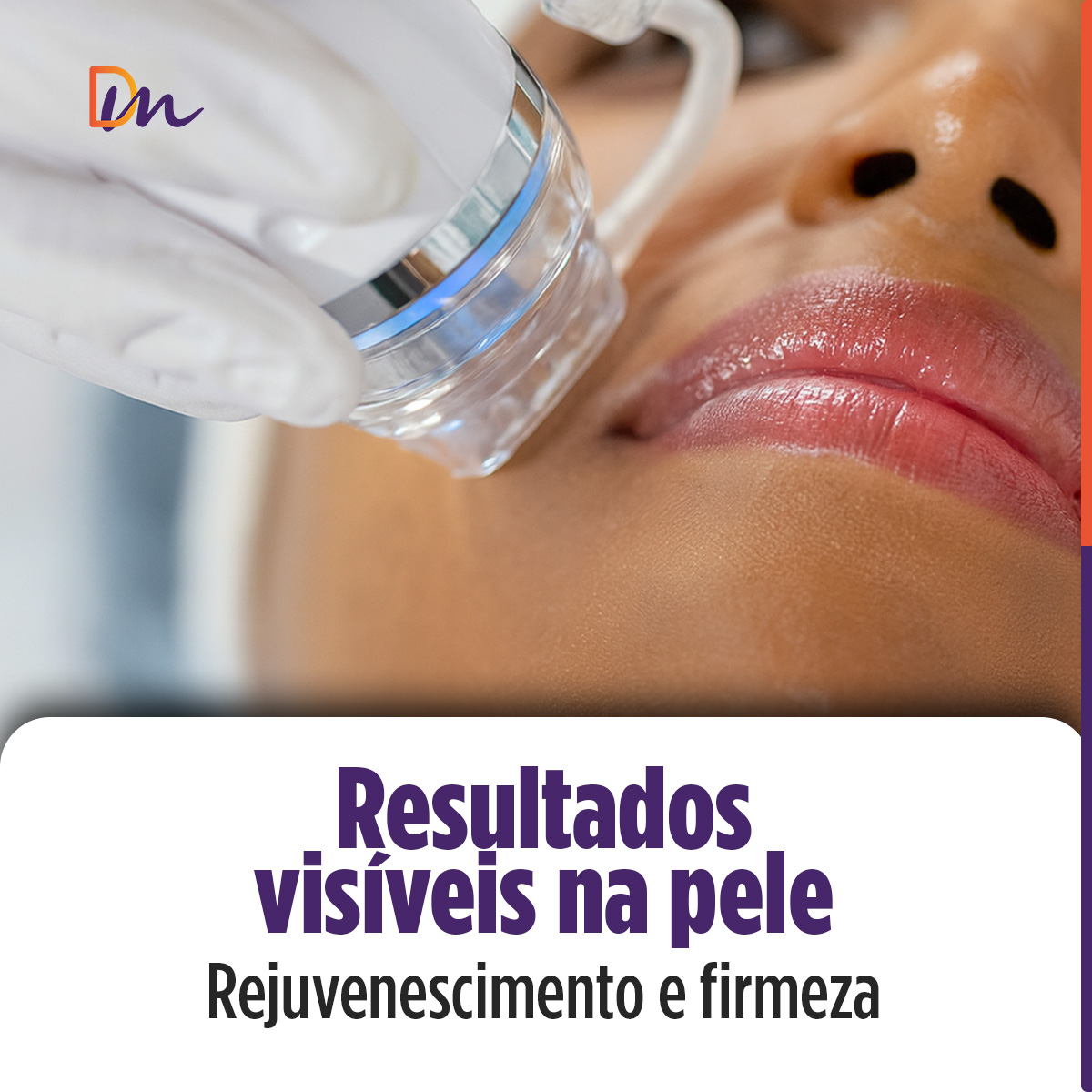 Needle RF Equipamento de Radiofrequência Microagulhada - HTM