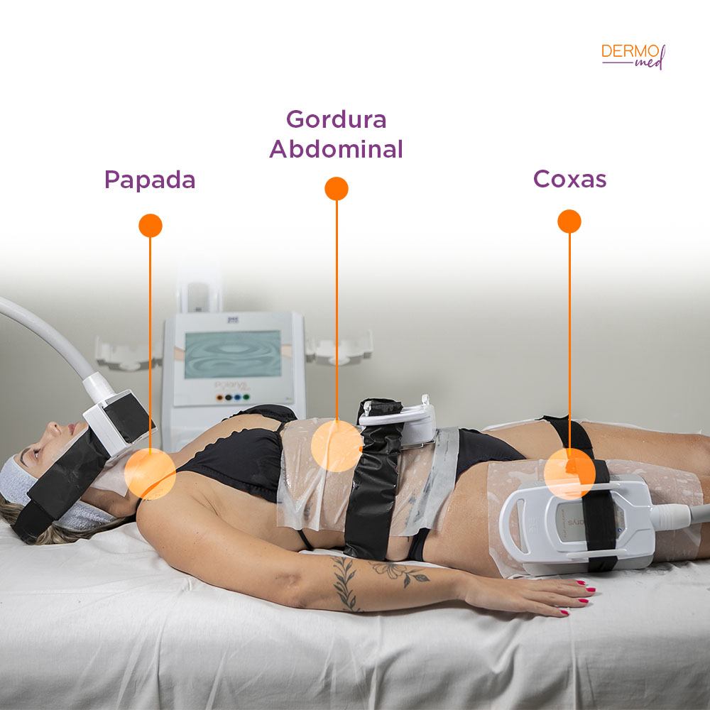 Aplicador Intercambiável Polarys Plaxx - Ibramed