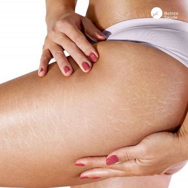 Estrias Brancas Mulher + 40 Anos : Loção Reduz Trata - 90g