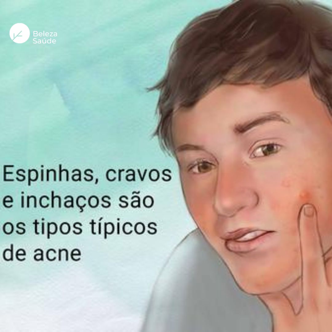 Composto Max Anti Acne, Comedões, Espinha, Cravo : 100 Caps