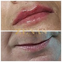 Preenchimento Labial - 1 ml de ácido hialurônico - PROMOÇÃO