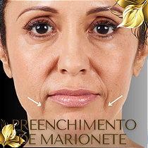 PREENCHIMENTO DE MARIONETE - 1 ml de ácido hialurônico - PROMOÇÃO