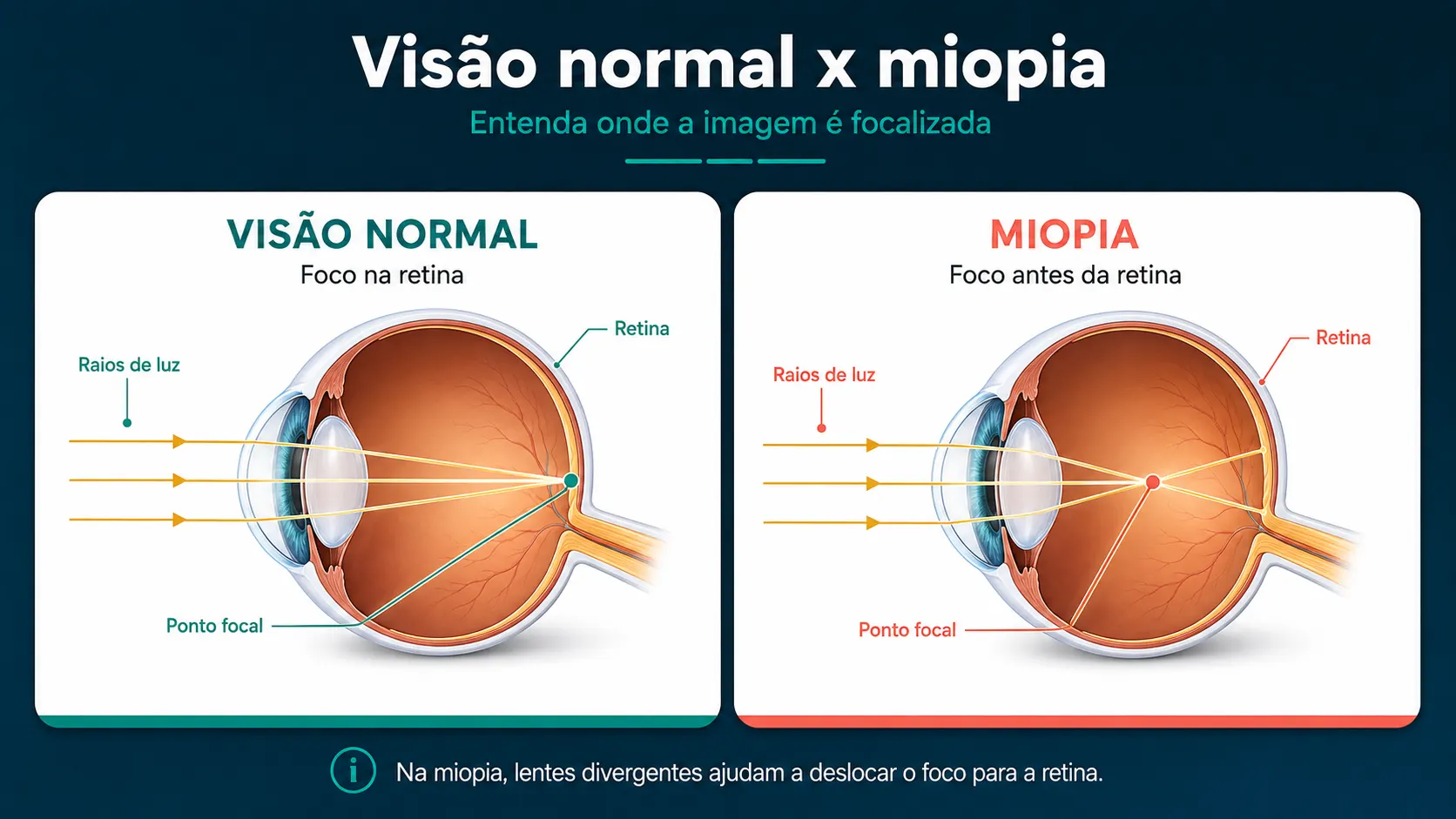 comparação entre a visão normal x visão que apresenta miopia - Óculos Vine