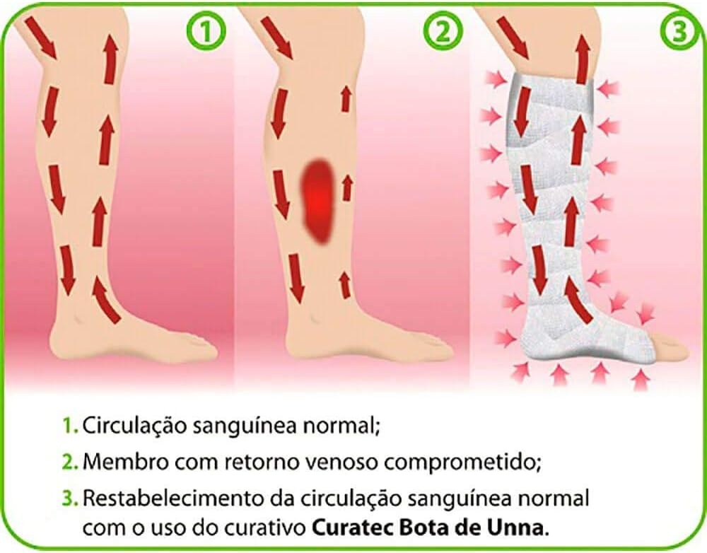 Curativo Bota de Unna 10,2cm x 9,14m Curatec - Sunnypé - Sunnypé ...