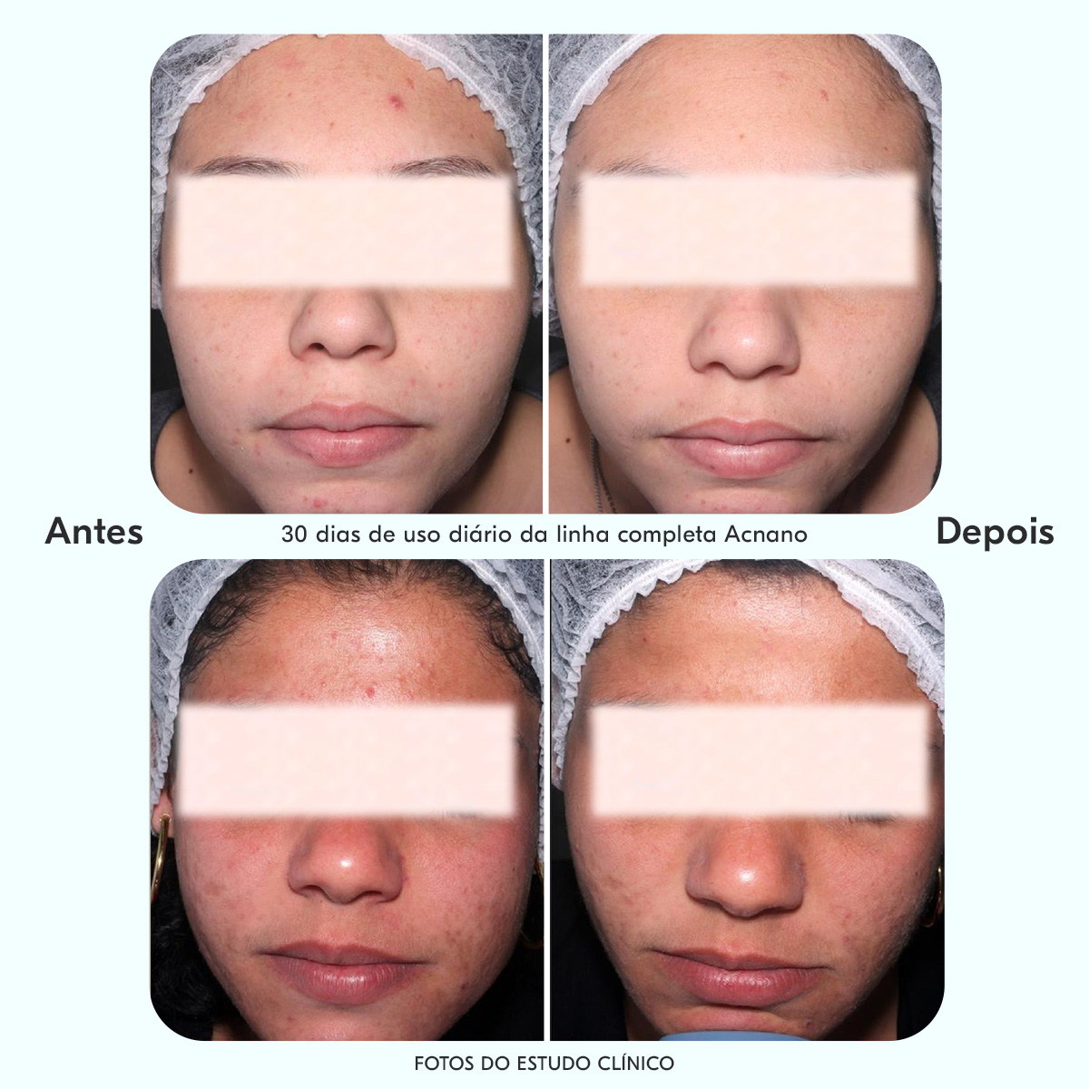 Acnano BlueActive Gel de Limpeza Antiacne - 300g - YEVA