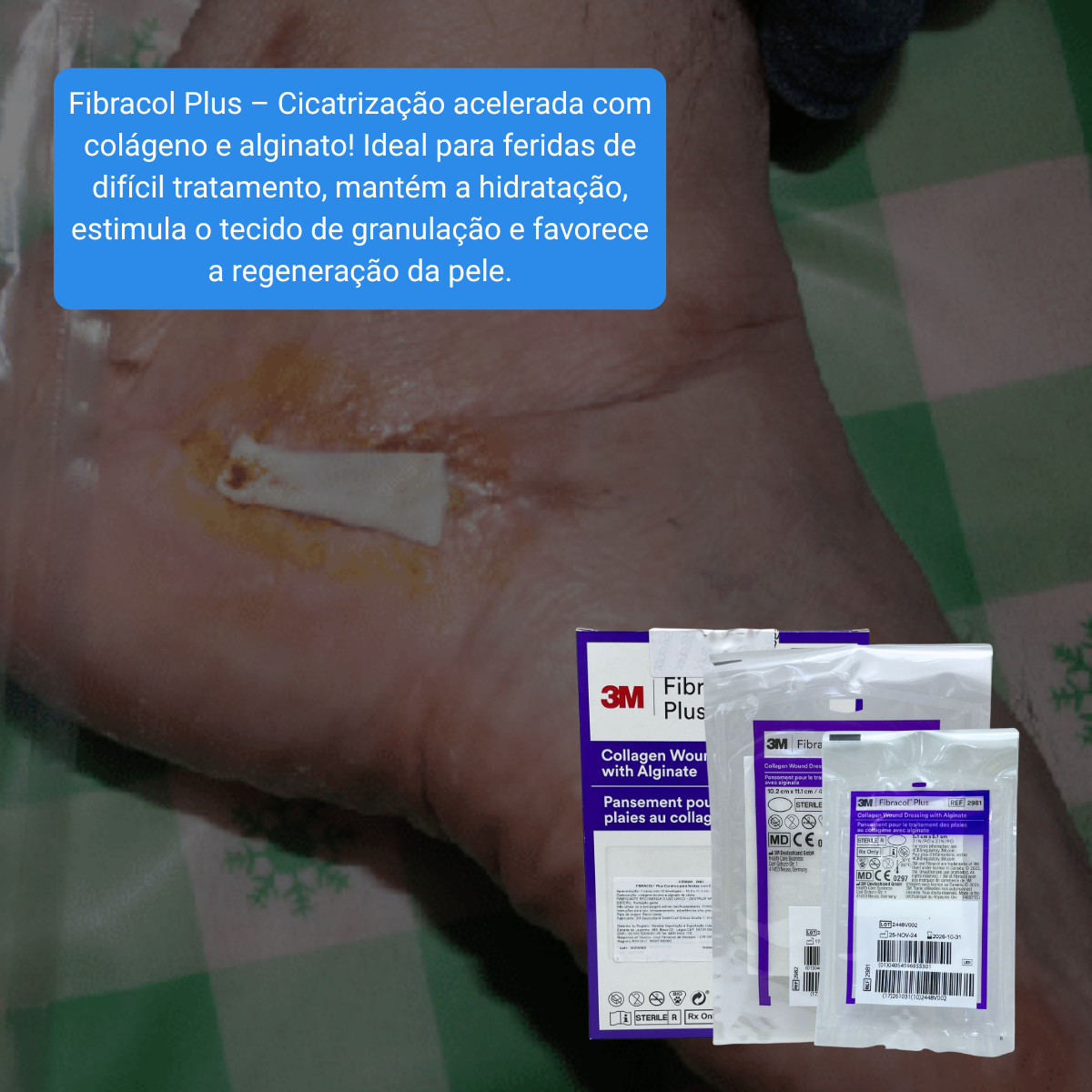 Fibracol Rope Curativo Fibracol Plus – Unidade - 3M - Produtos Médicos e Hospitalares ...