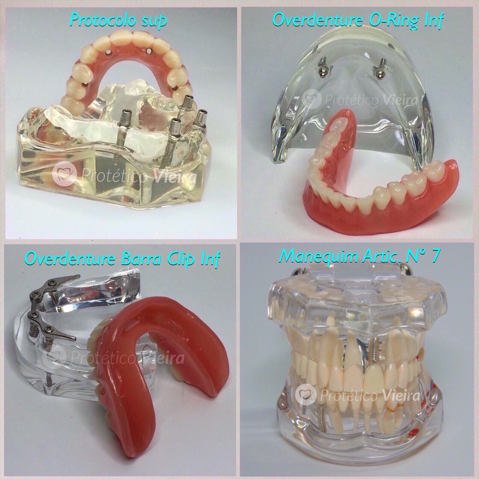 manequim odontológico articulado, protocolo, overdenture barra clip, o -  Manequins Odontológicos Protético Vieira