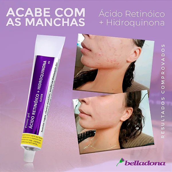 Kit 2 Cremes Gel Ácido Retinóico e Hidroquinona | 30g - Farmácia ...