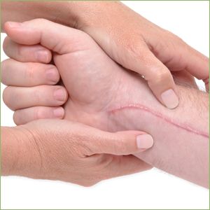 Cicatrização e Feridas