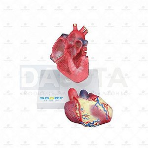 Modelo Patológico Do Coração Com Hipertrofia Em 2 Partes