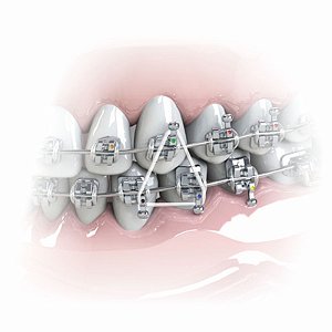 Elástico Intraoral "Silicone" Médio 1/4"