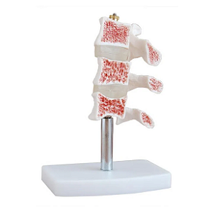 Modelo Estrutura Óssea Osteoporótica- 4D ANATOMY