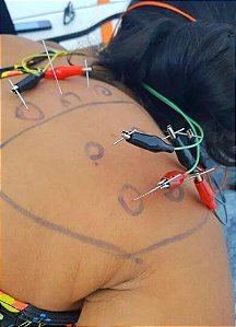 Curso Presencial: Dry Needling + Eletroestimulação Intramuscular - (18 e 19 de Novembro de 2023 em RECIFE/PE)