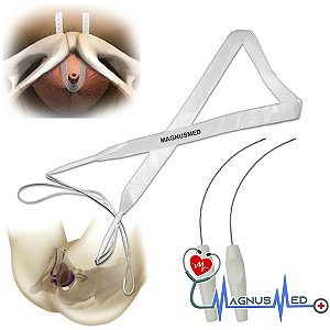 Sling com Agulha Suprapubica / Retropubico - Dispositivo Implantável Para Incontinência Urinaria - KFF