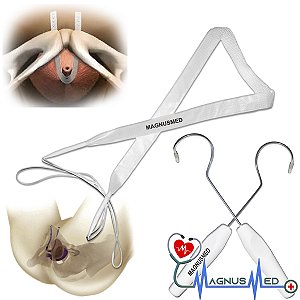 Sling com Agulha Transobturatorio / Transvaginal - Dispositivo Implantável Para Incontinência Urinaria - KFF