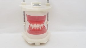 Typodont - Classe I com apinhamento moderado superior e inferior, extrações dos prés-molares com mini-implantes