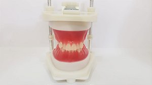 Typodont - Classe II com apinhamento severo nos superiores, suave nos inferiores sem mini implantes