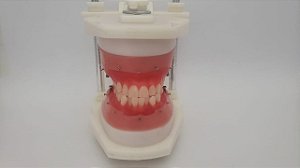Typodont - Classe lll inferior anteriores apinhados com mini implantes
