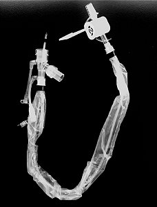 DUPLICADO - SISTEMA FECHADO DE ASPIRAÇÃO TRAQUEAL - Trach Clean - BIOMEDIKA - 72HRS - 16FR