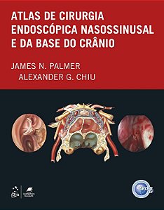 Atlas de Cirurgia Endoscópica Nasossinusal e da Base do Crânio - James N. Palmer; Alexander G. Chiu