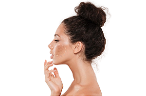 Tratamento Para Melasma Persistente