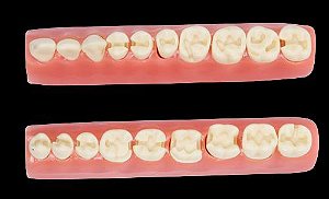 Homólogo Par 20 Dentes com Preparo Cavitário