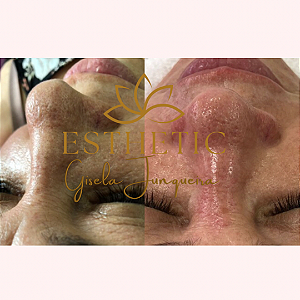 Limpeza de pele premium