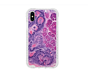 Capa para Celular Histopatologia Tricoblastoma