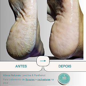 Nanofeet 50g - Creme de Hidratação para Rachaduras