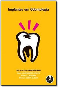 Implantes Em Odontologia