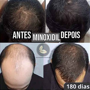 Minoxidil Oral Estimulante do Crescimento Capilar