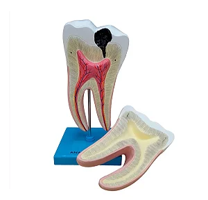 Dente Molar Ampliado - Saudável e com Cárie