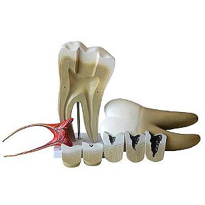 Dente Molar Ampliado com Evolução da Cárie, em 8 Partes