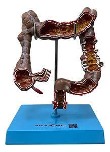 Intestino Grosso com Patologia