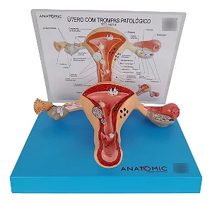 Útero com Trompas Patológico