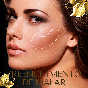 PREENCHIMENTO DE MALAR - 1 ml de ácido hialurônico - PROMOÇÃO