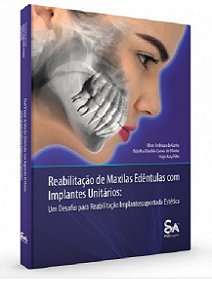 Livro Reabilitacao de Maxilas Edentulas com Implantes Unitarios: Um Desafio para - Cunha