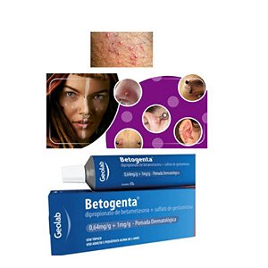 Betogent Pomada Para queloide de piercing