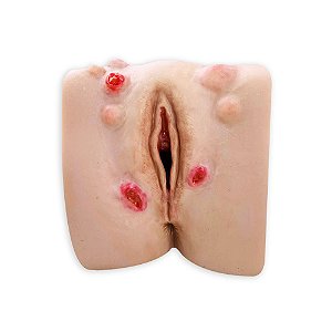 SIMULADOR DE PATOLOGIAS VULVARES NINFOTRAINER - VLV-15 VULVA COM LINFADENITE, LINFOGRANULOMA INGUINAL (MAT. PEDAG)