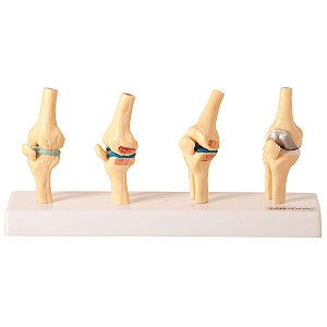 Comparação do Joelhos Saudável e Patológico - TGD-0164-P
